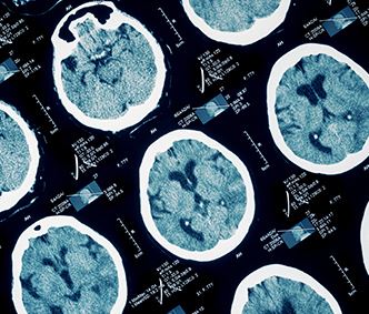 Traumatic Brain Injury